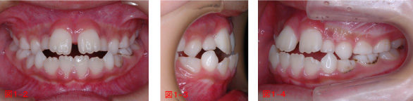 小児の矯正治療例の写真