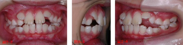 小児の矯正治療例の写真