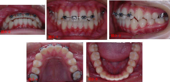 こどもの矯正終了(第1期治療)時12歳11カ月の写真