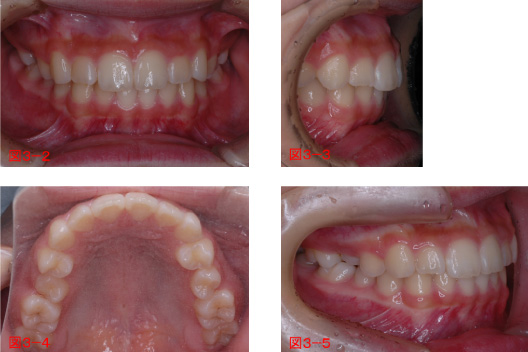 こどもの矯正終了(第1期治療)時12歳11カ月の写真