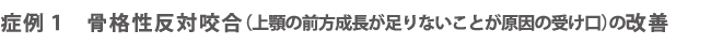症例1骨格性反対咬合（上顎の前方成長が足りないことが原因の受け口）の改善