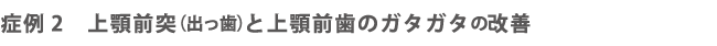 症例2上顎前突(出っ歯）と上顎前歯のガタガタの改善