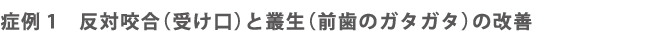症例1反対咬合（受け口）と叢生（前歯のガタガタ）の改善