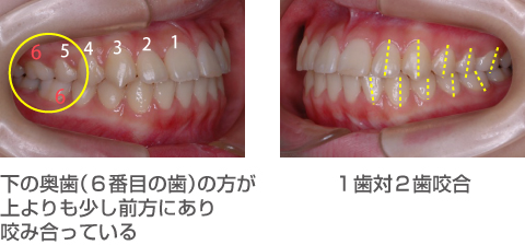 下の奥歯（６番目の歯）の方が上よりも少し前方にあり咬み合っている,１歯対２歯咬合の写真