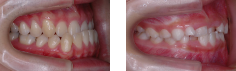 受け口(反対咬合、下顎前突)例の写真