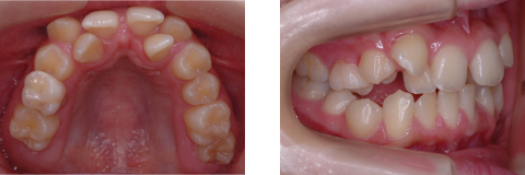 叢生(八重歯)例の写真