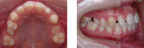 空隙歯列（すきっ歯）例の写真
